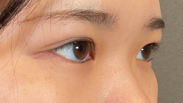 手術前の状態 その1