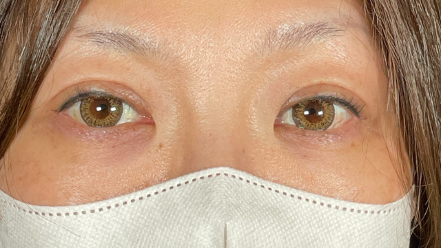 手術前の状態 その1