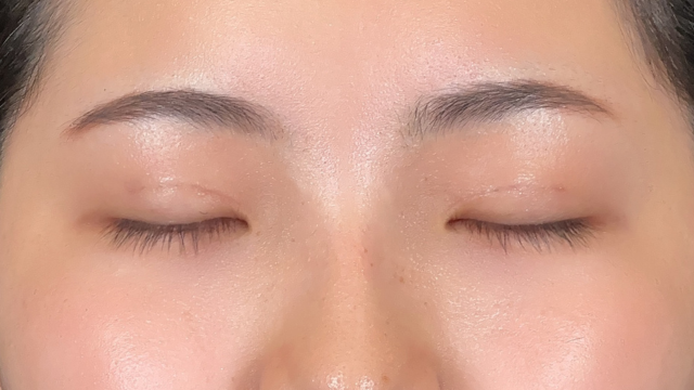 手术前的状态 其一