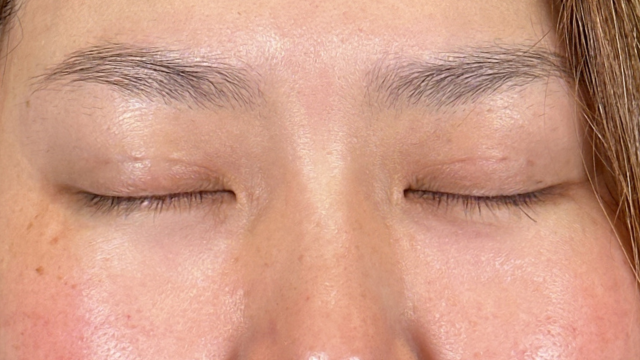 手术前的状态 其一