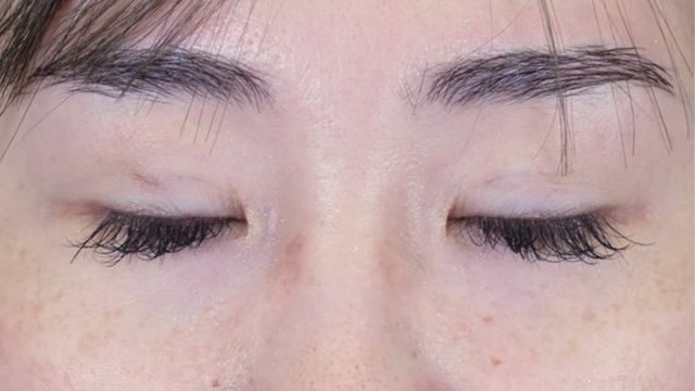 手術前の状態 その1