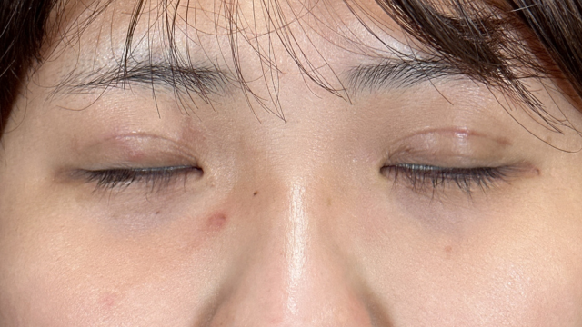 手术前的状态 其一