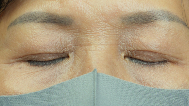 手术前的状态 其一