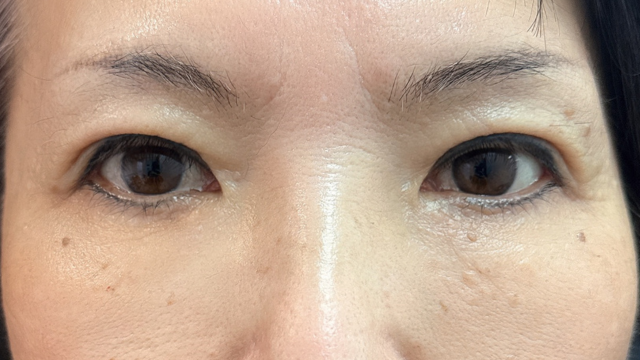 手術前の状態 その1