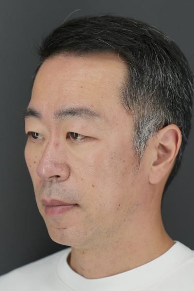 手術前の状態 その1