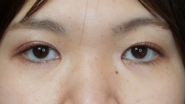 手術前の状態 その1