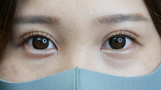 手術前の状態 その1