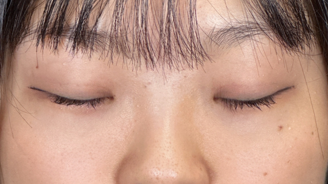 手術前の状態 その1