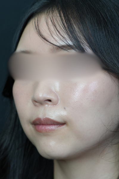 手術前の状態 その1