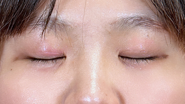 手术前的状态 其一