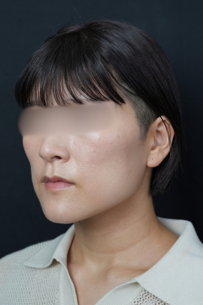 手術前の状態 その1