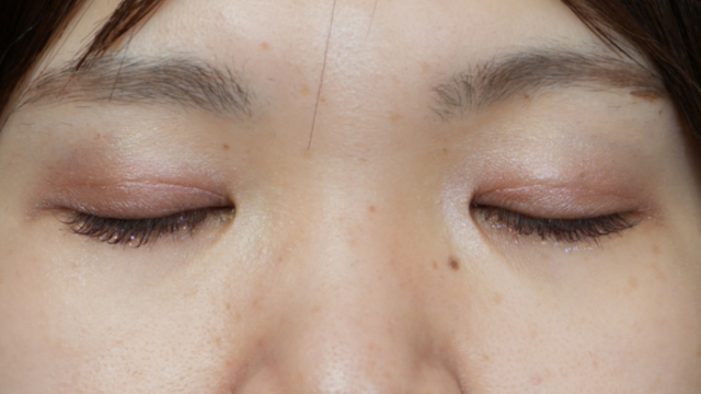 手术前的状态 其一