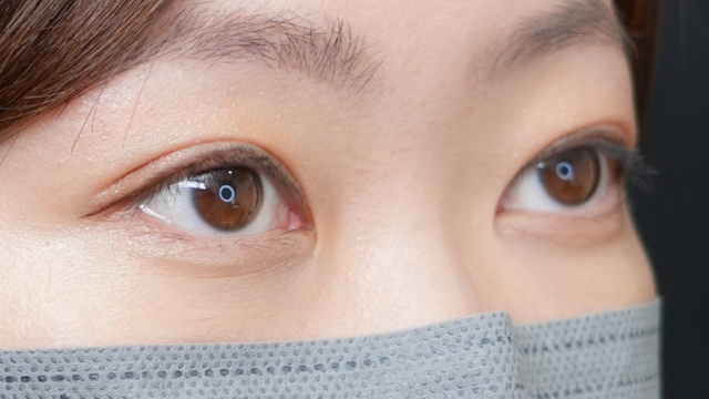 手術前の状態 その1