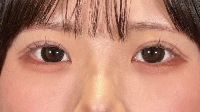 手術前の状態 その1