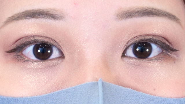 手術前の状態 その1