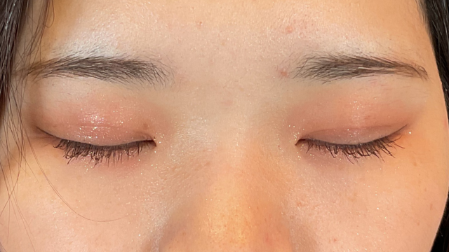 手術前の状態 その1