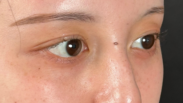 手术前的状态 其一