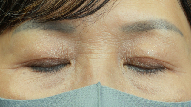 手术前的状态 其一