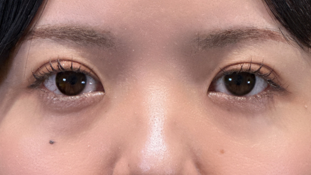 手術前の状態 その1