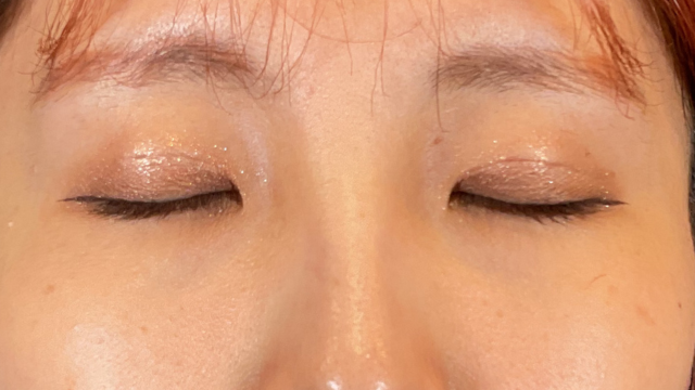 手術前の状態 その1