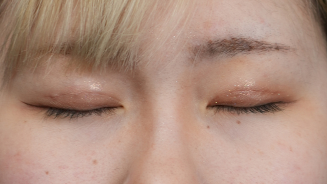 手术前的状态 其一