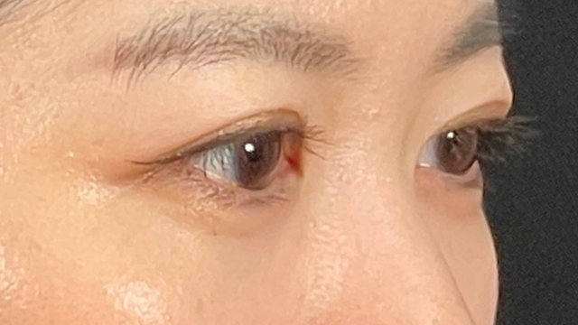 手術前の状態 その1