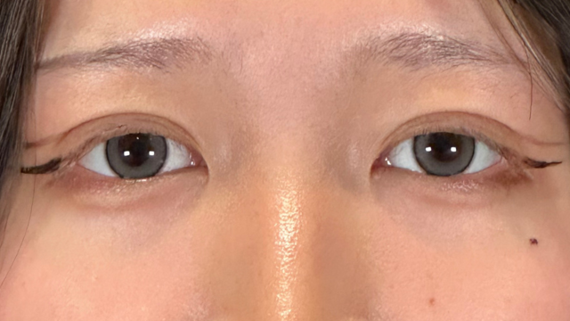 手术前的状态 其一