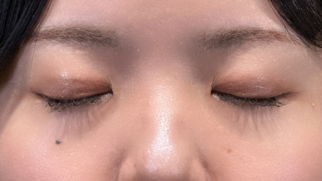 手術前の状態 その1