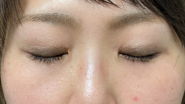 手术前的状态 其一