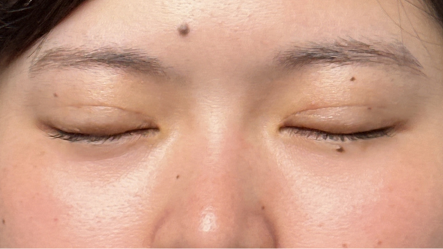 手术前的状态 其一