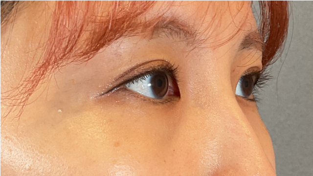 手術前の状態 その1