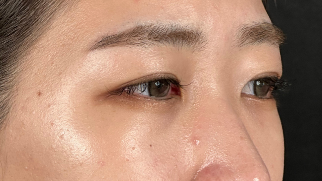 手术前的状态 其一