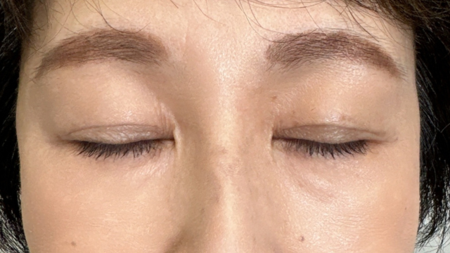 手术前的状态 其一