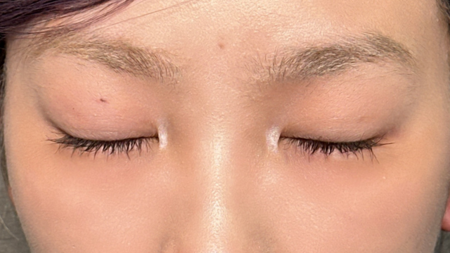 手术前的状态 其一