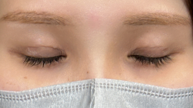 手术前的状态 其一