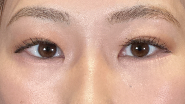 手術前の状態 その1