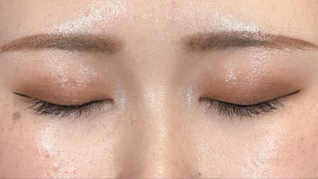 手術前の状態 その1