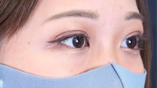 手術前の状態 その1