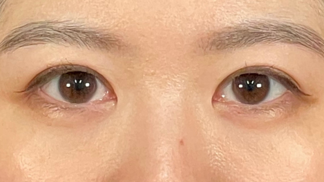 手術前の状態 その1