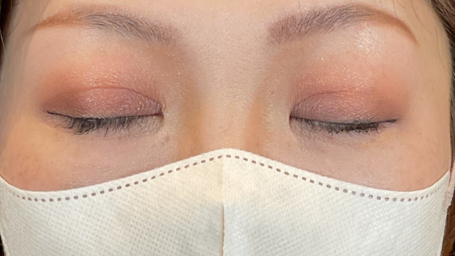 手術前の状態 その1