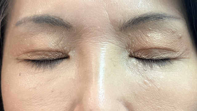 手術前の状態 その1