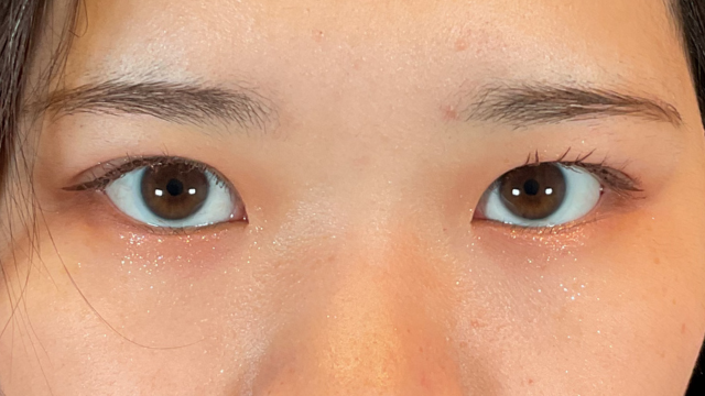 手術前の状態 その1