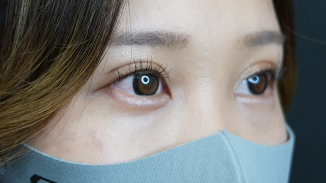 手術前の状態 その1