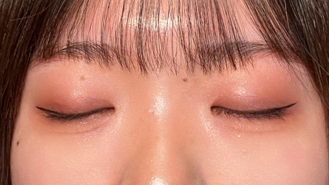 手术前的状态 其一