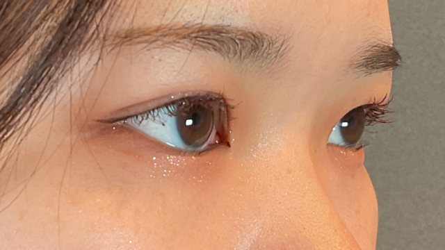 手術前の状態 その1