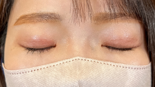 手术前的状态 其一