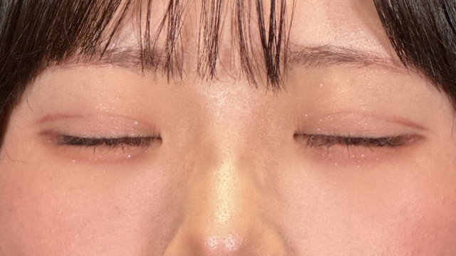 手術前の状態 その1