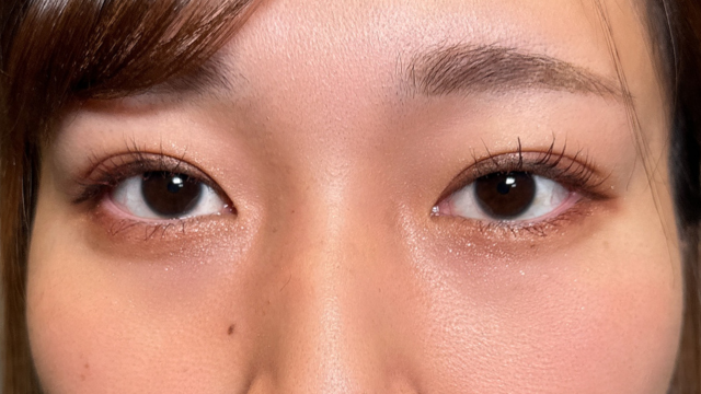 手術前の状態 その1