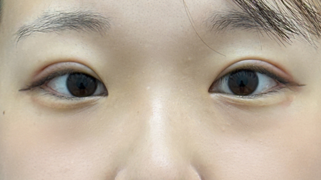 手术前的状态 其一