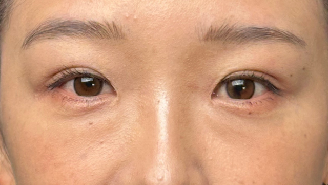 手术前的状态 其一